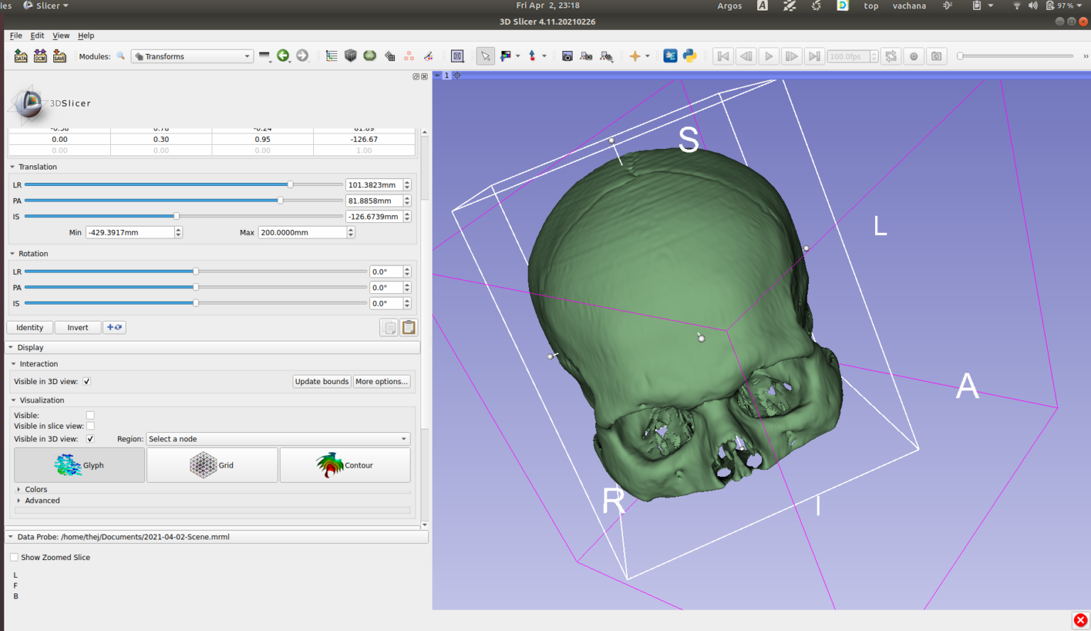 Exploring Dicom Images With 3d Slicer Thejesh Gn 3751